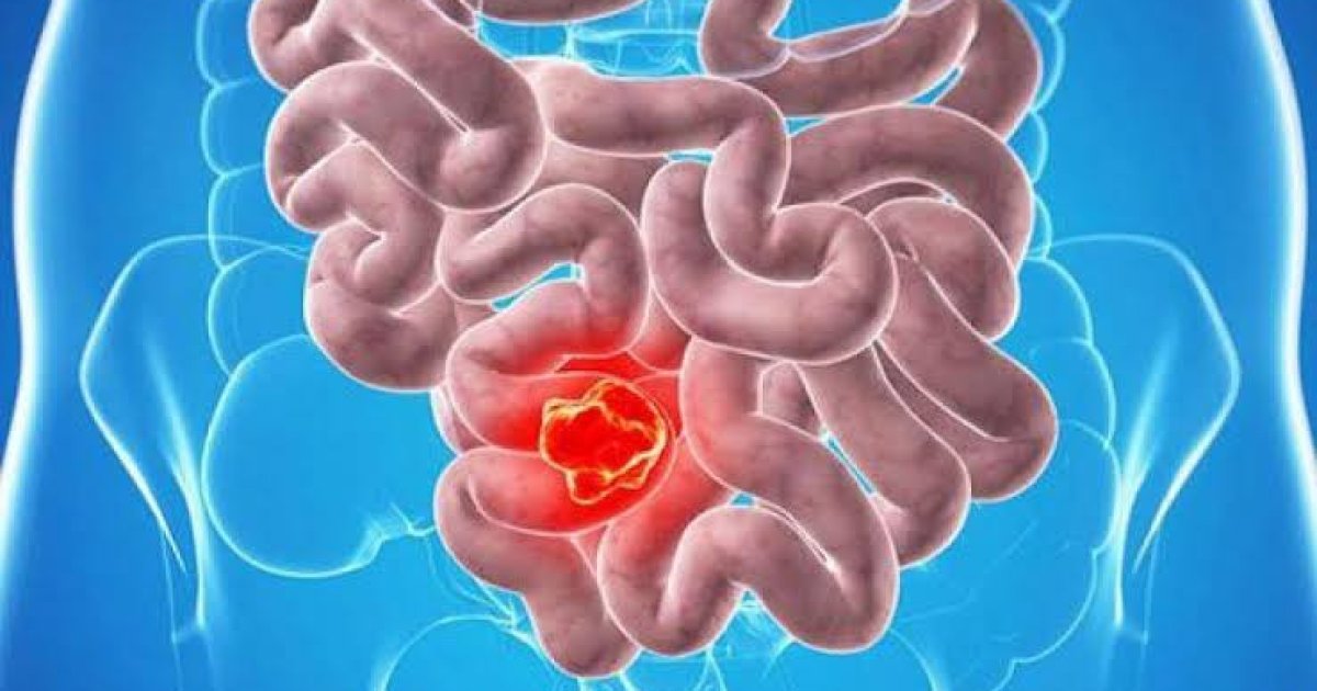 هغه خواړه چې د کولمو په سرطان له اخته کېدو څخه مو ژغوري