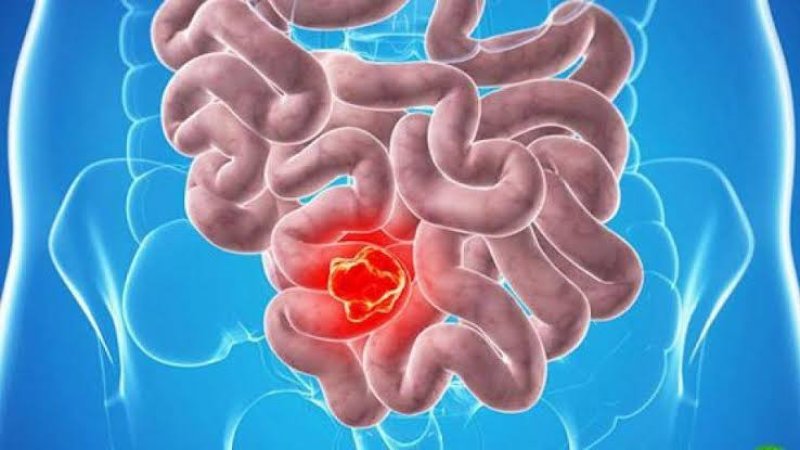 هغه خواړه چې د کولمو په سرطان له اخته کېدو څخه مو ژغوري