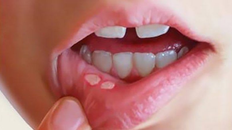 د خولې د نارغيو لاملونه او درملنه!