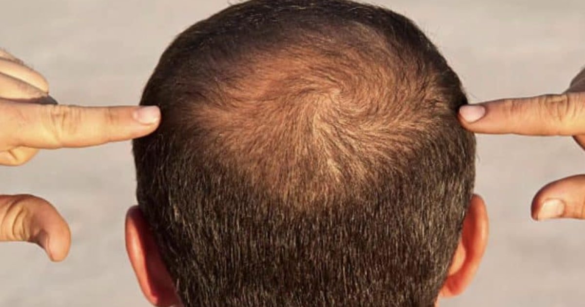 د ویښتانو تویېدنې ځينې لامولونه!